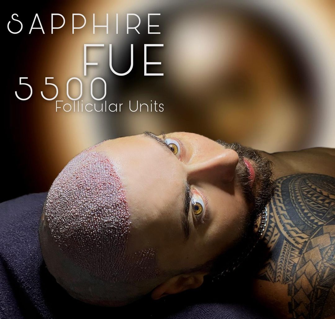 Fue Hair Transplant