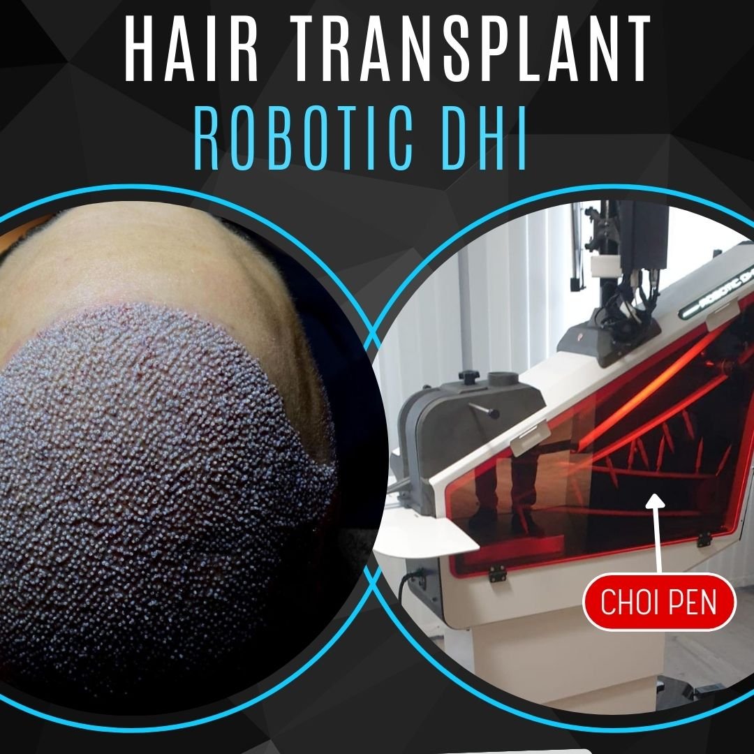 Robotic DHI Hair Transplant