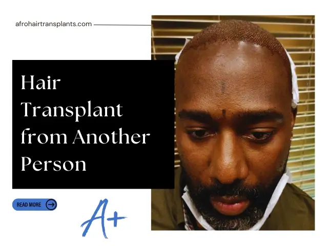 Hair Transplant from Another Person