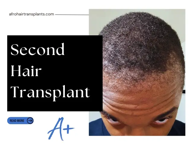 Second Hair Transplant