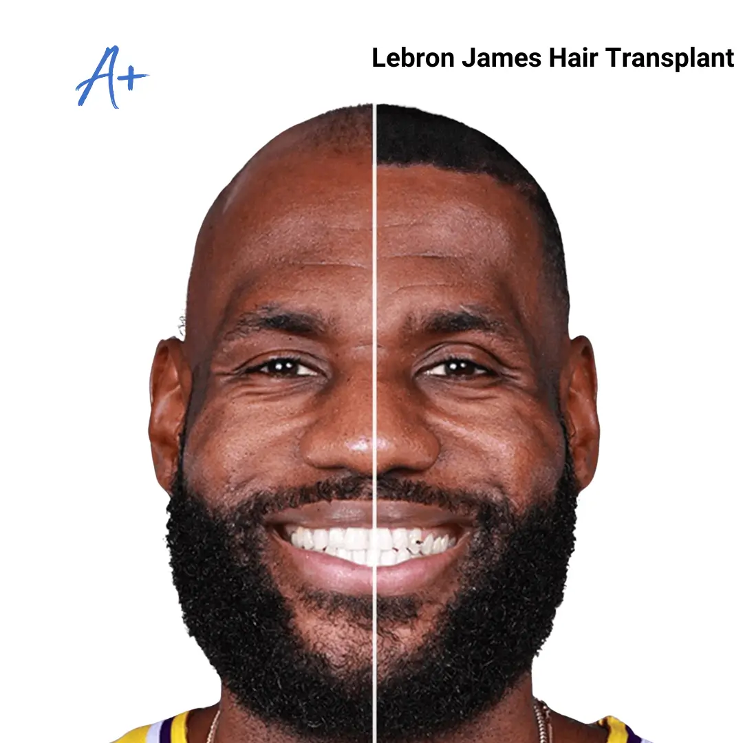 Lebron James hair transplant
