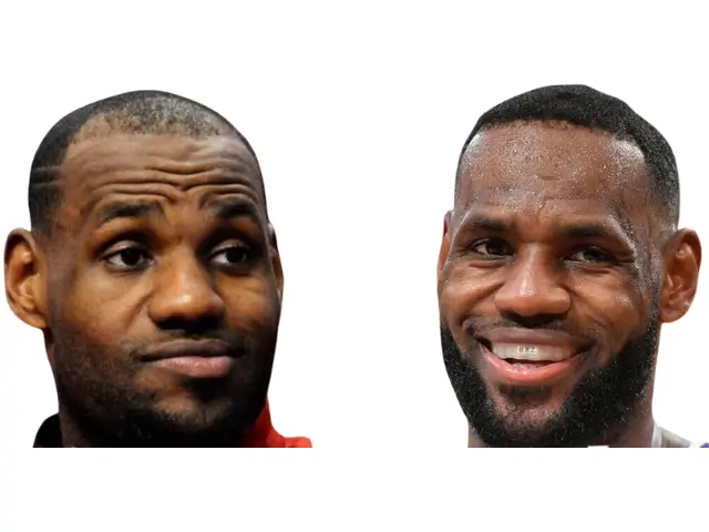 lebron james hair transplant before and after