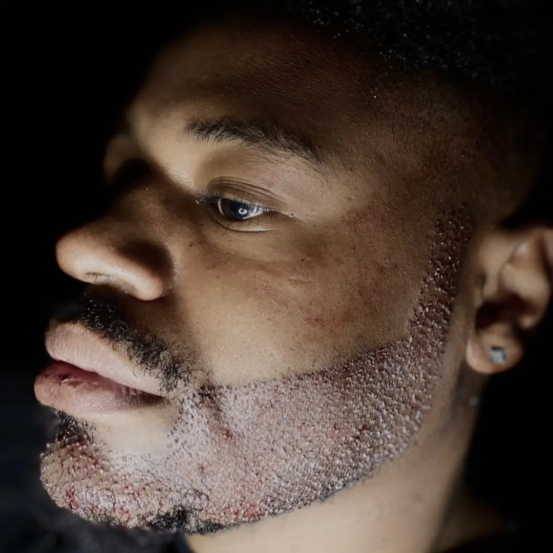 Afro beard transplant
