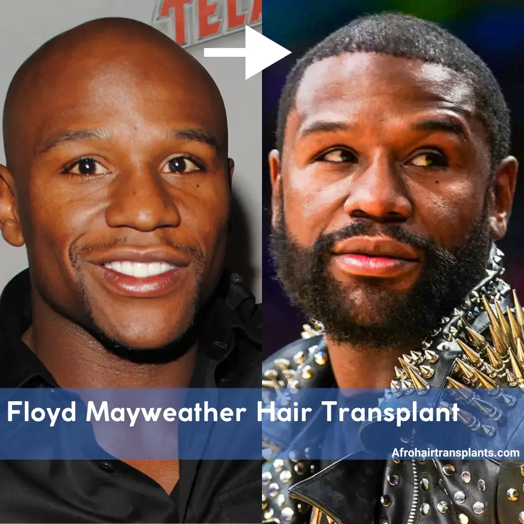 Floyd Mayweather Hair Transplant