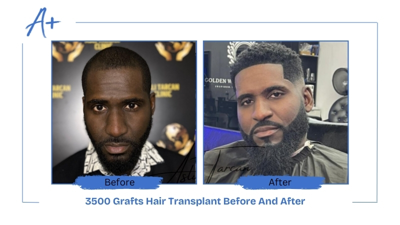 3500 Grafts Hair Transplant Before And After