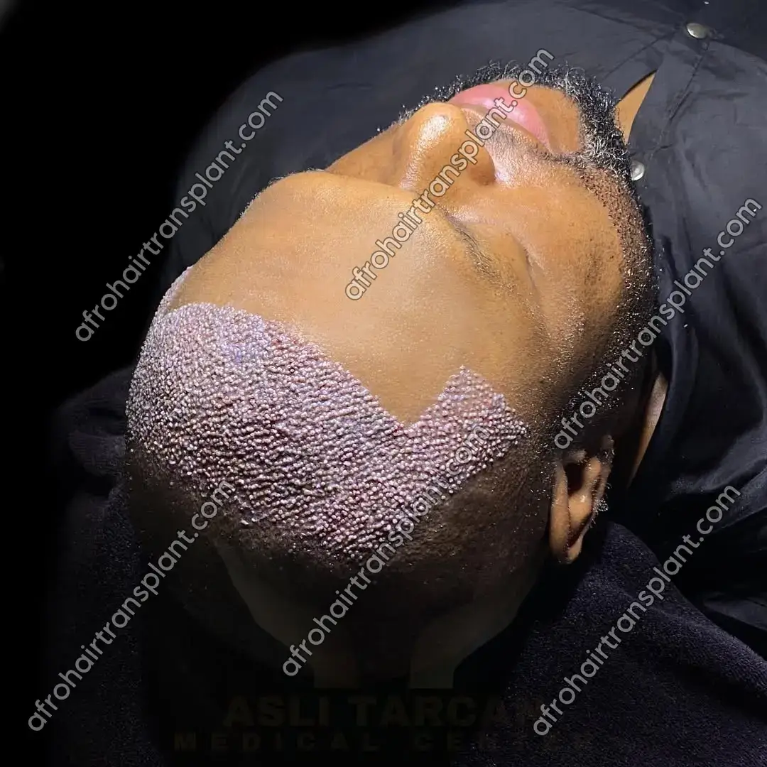 Prevent & Reduce Swelling or Post-operative Oedema After Hair Transplant