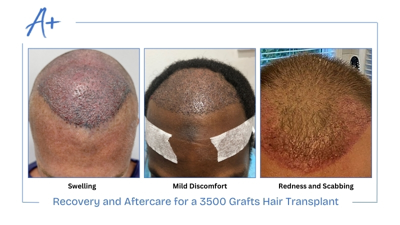 Recovery and Aftercare for a 3500 Grafts Hair Transplant