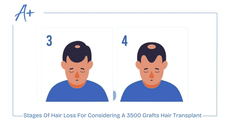 Stages Of Hair Loss For Considering A 3500 Grafts Hair Transplant