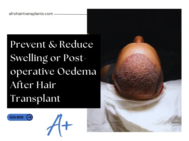 Swelling After Hair Transplant