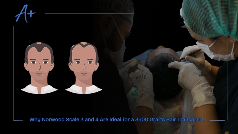 Why Norwood Scale 3 and 4 Are Ideal for a 3500 Grafts Hair Transplant
