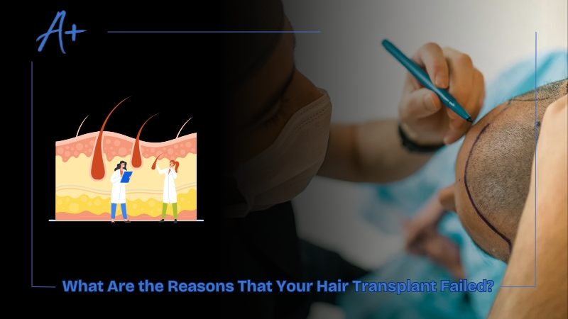 What Are the Reasons That Your Hair Transplant Failed What Are the Reasons That Your Hair Transplant Failed