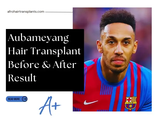 Aubameyang Hair Transplant Before & After Result