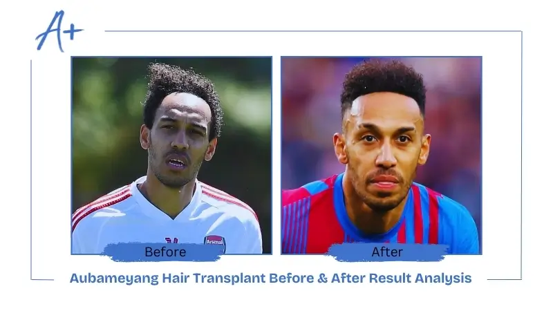 Aubameyang Hair Transplant Before & After