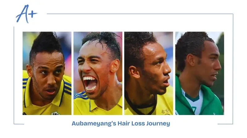 Aubameyang’s Hair Loss Journey