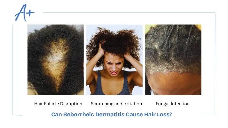 Can Seborrheic Dermatitis Cause Hair Loss