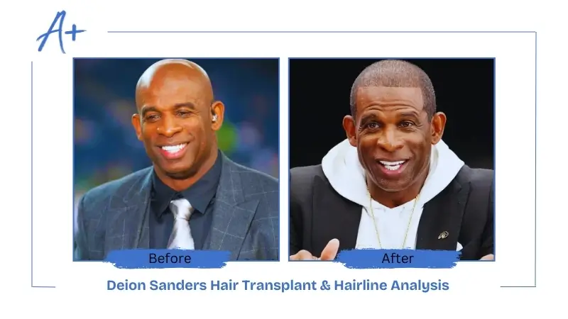Deion Sanders Hair Transplant