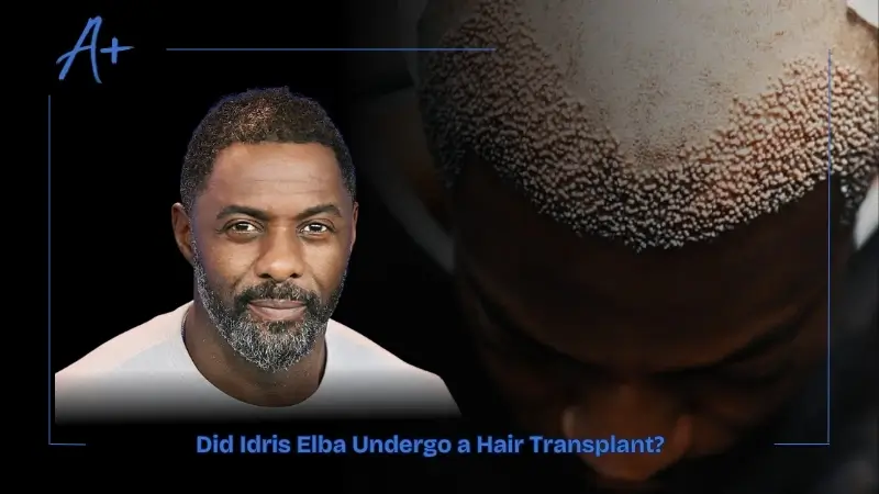 Did Idris Elba Undergo a Hair Transplant