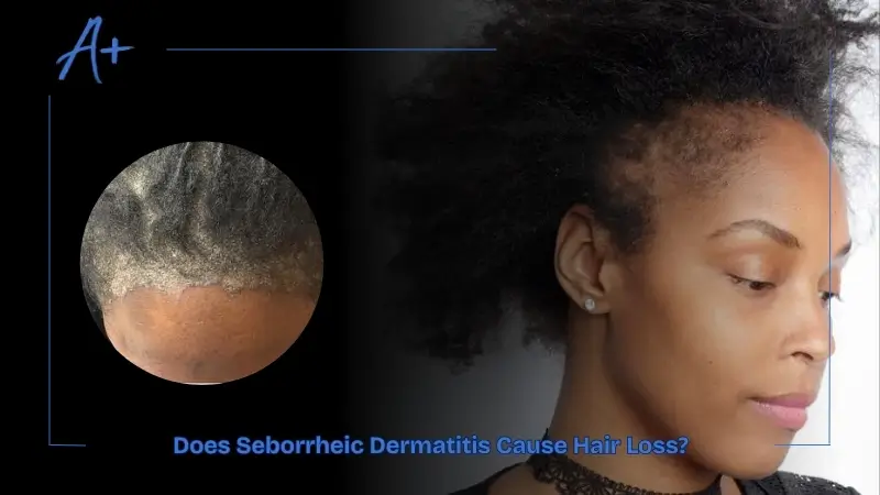 Does Seborrheic Dermatitis Cause Hair Loss