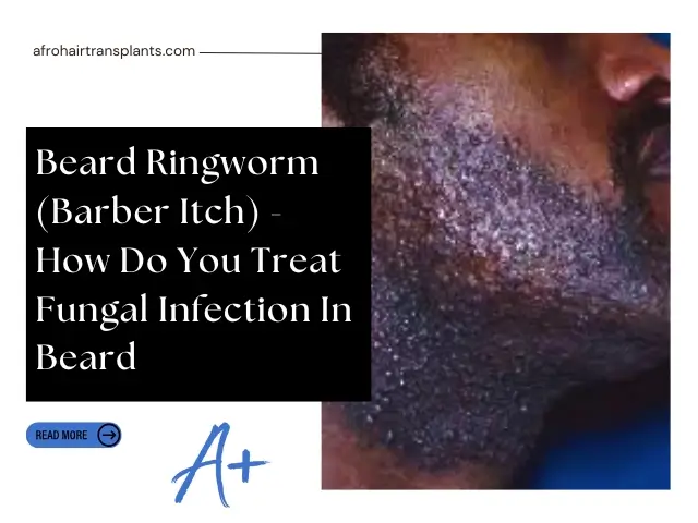 How Do You Treat Fungal Infection In Beard