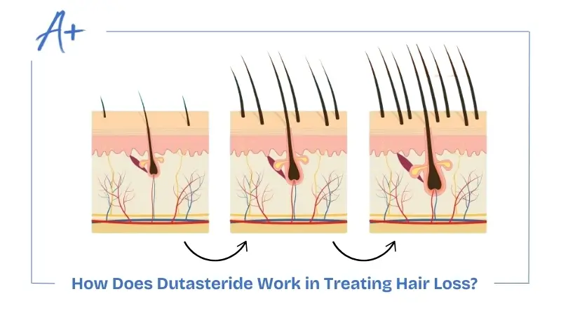 How Does Dutasteride Work in Treating Hair Loss