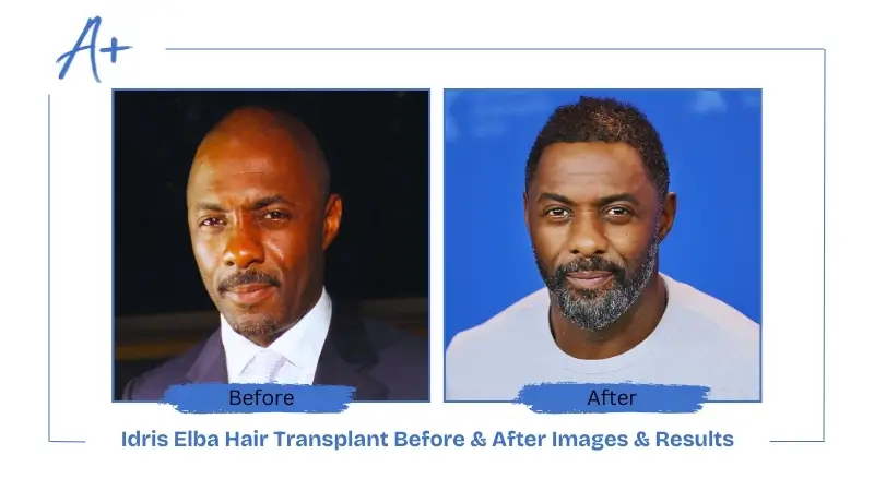 Idris Elba Hair Transplant Before & After Images & Results