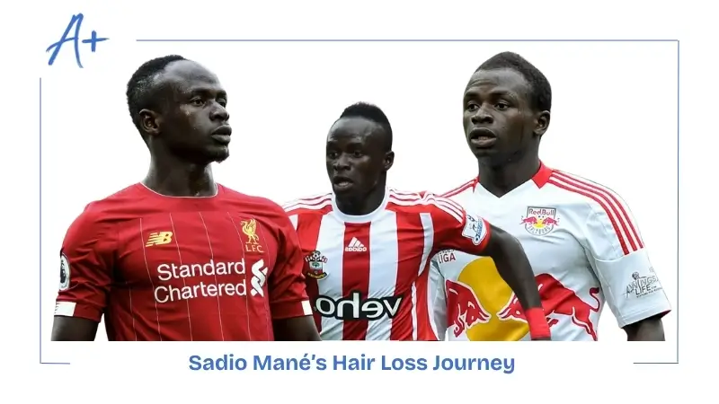 Sadio Mané’s Hair Loss Journey