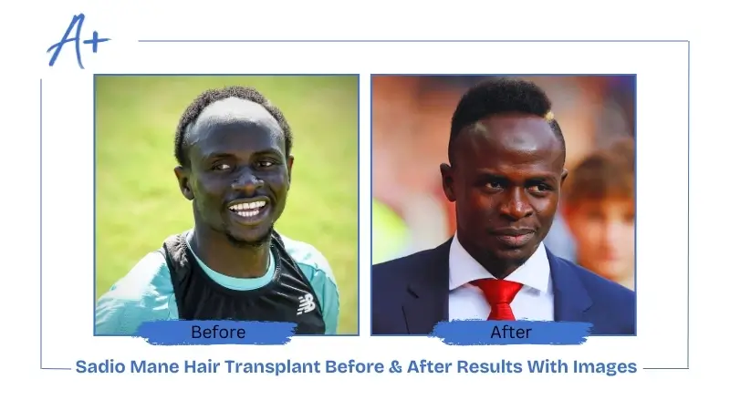 Sadio Mané’s New Hairline before and after