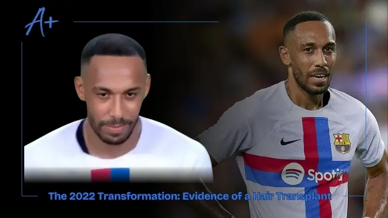 The 2022 Transformation Evidence of a Hair Transplant