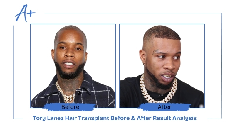 Tory Lanez Hair Transplant Before & After Result Analysis