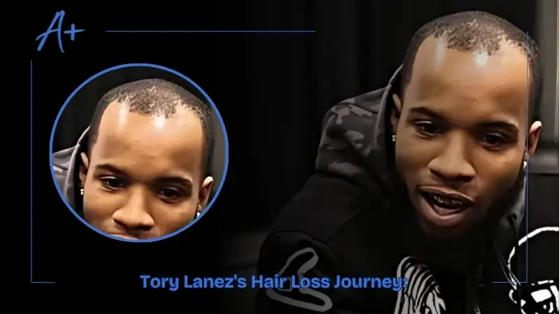 Tory Lanez's Hair Loss Journey