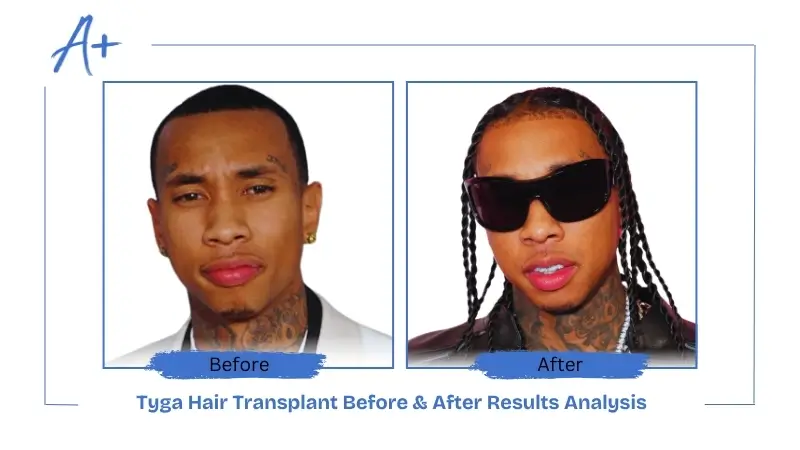 Tyga Hair Transplant Before & After Results Analysis
