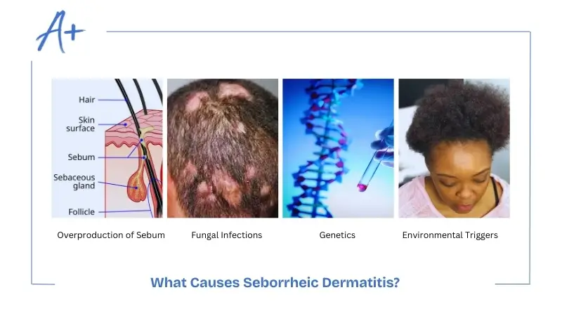What Causes Seborrheic Dermatitis