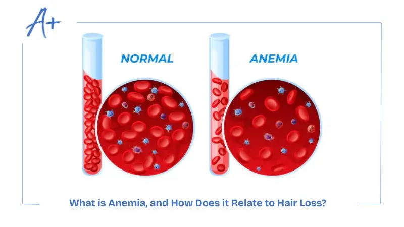 What is Anemia, and How Does it Relate to Hair Loss