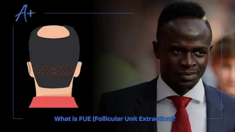 What is FUE (Follicular Unit Extraction)