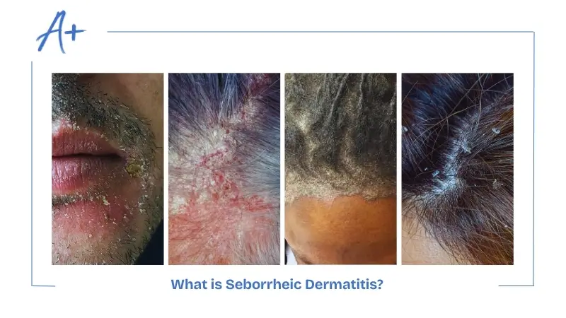 What is Seborrheic Dermatitis