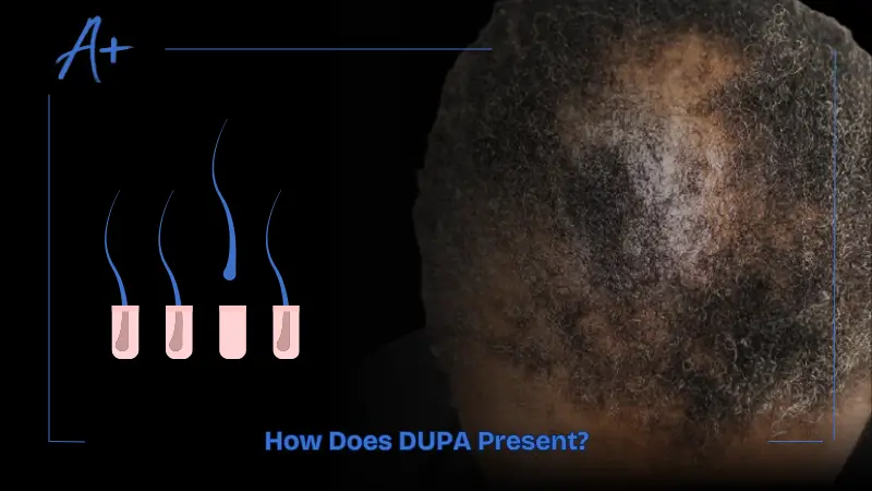 How Does DUPA Present How Does DUPA Present