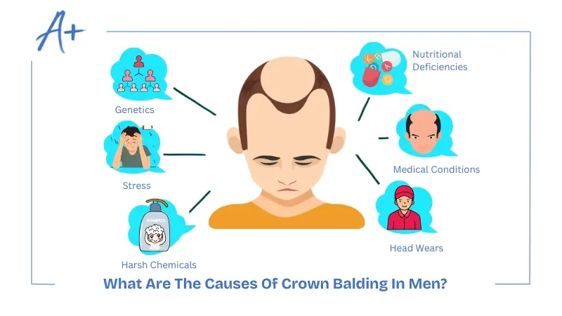 What Are The Causes Of Crown Balding In Men What Are The Causes Of Crown Balding In Men