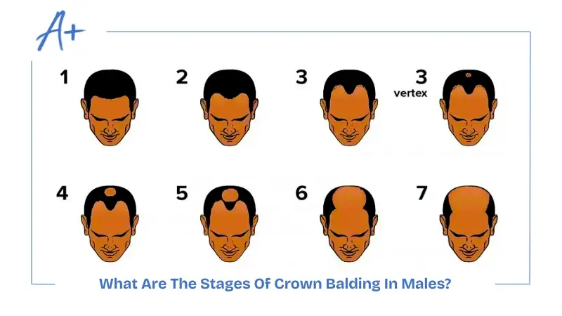 What Are The Stages Of Crown Balding In Males What Are The Stages Of Crown Balding In Males