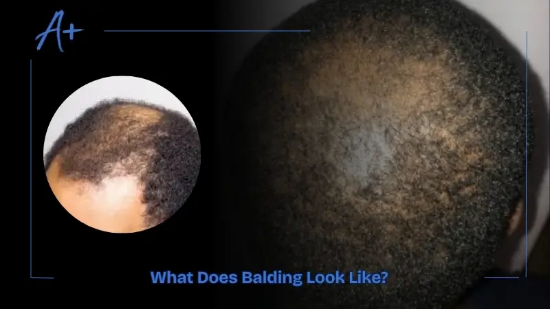 What Does Balding Look Like
