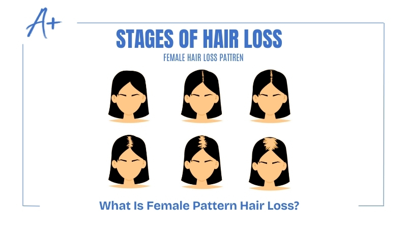 What Is Female Pattern Hair Loss