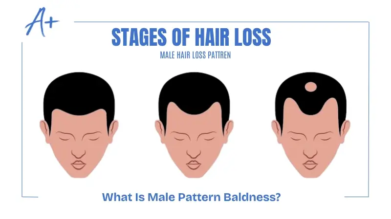 What Is Male Pattern Baldness What Is Male Pattern Baldness