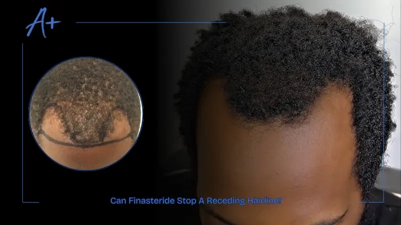 Can Finasteride Stop A Receding Hairline