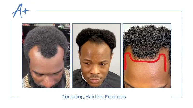 Receding Hairline Features Receding Hairline Features