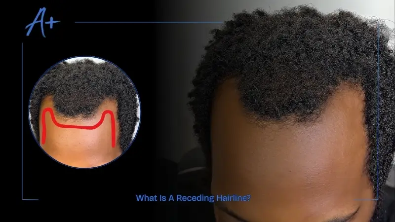 What Is A Receding Hairline What Is A Receding Hairline