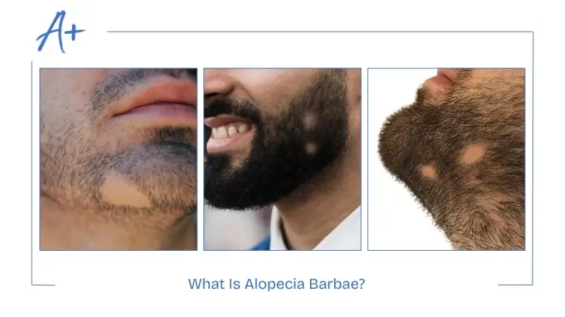 What Is Alopecia Barbae