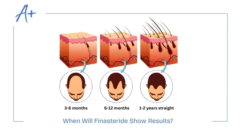 When Will Finasteride Show Results